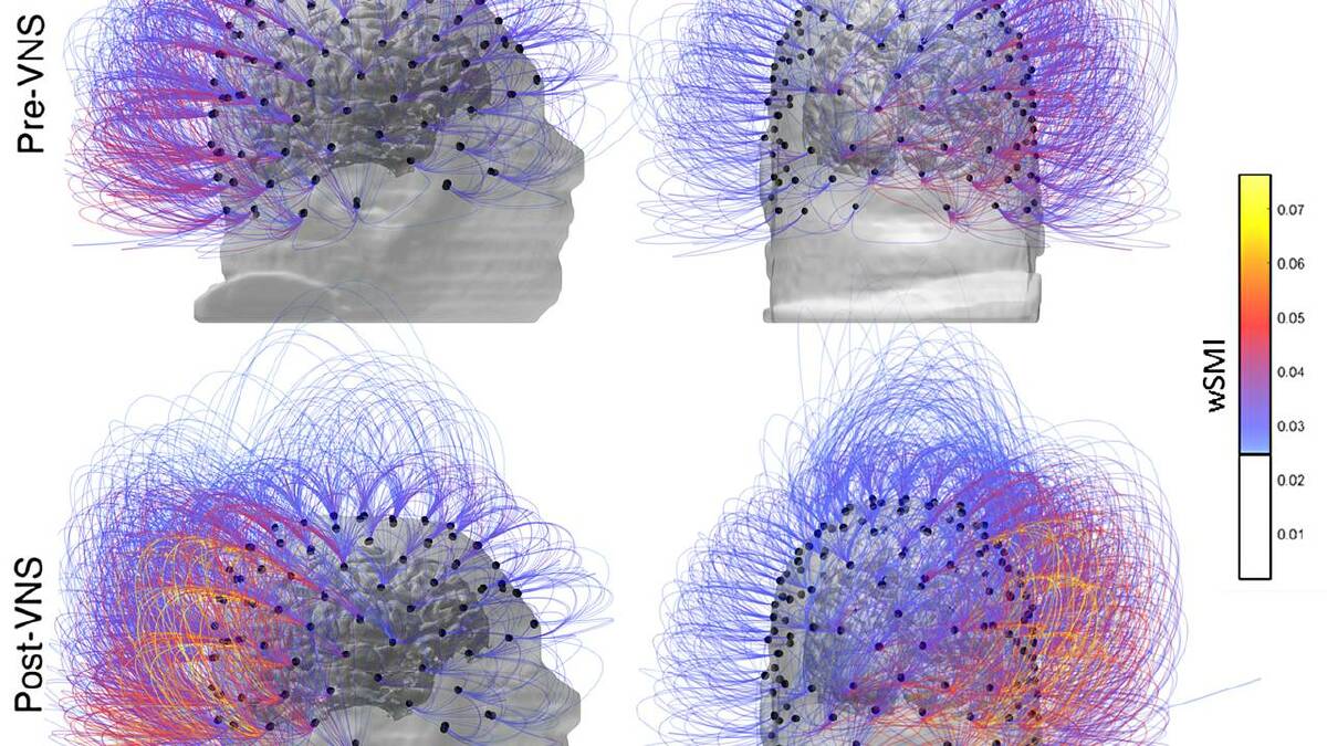 VNS helps diminish seizures, with warmer colours here indicating an increase in connectivity. (AP PHOTO)